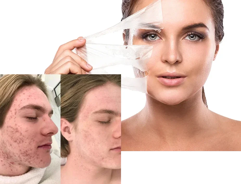 Peeling-Quimico Peeling-Quimico