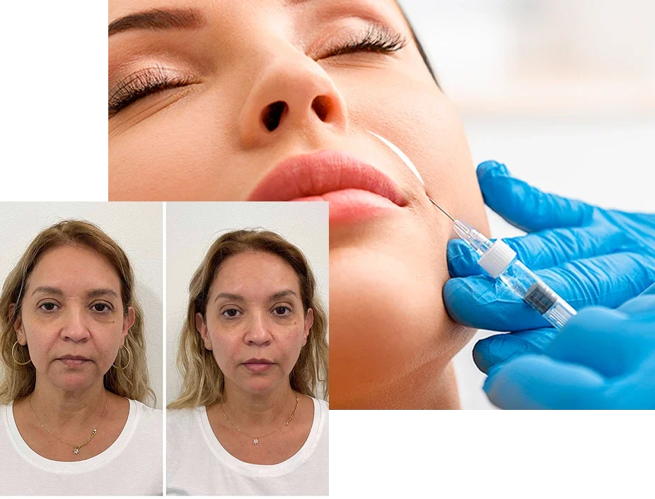 Relleno-Nasogeniano Relleno-Nasogeniano