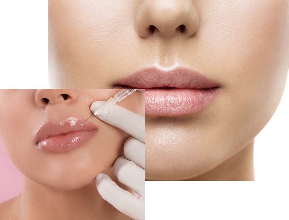 Relleno de Labios Relleno de Labios