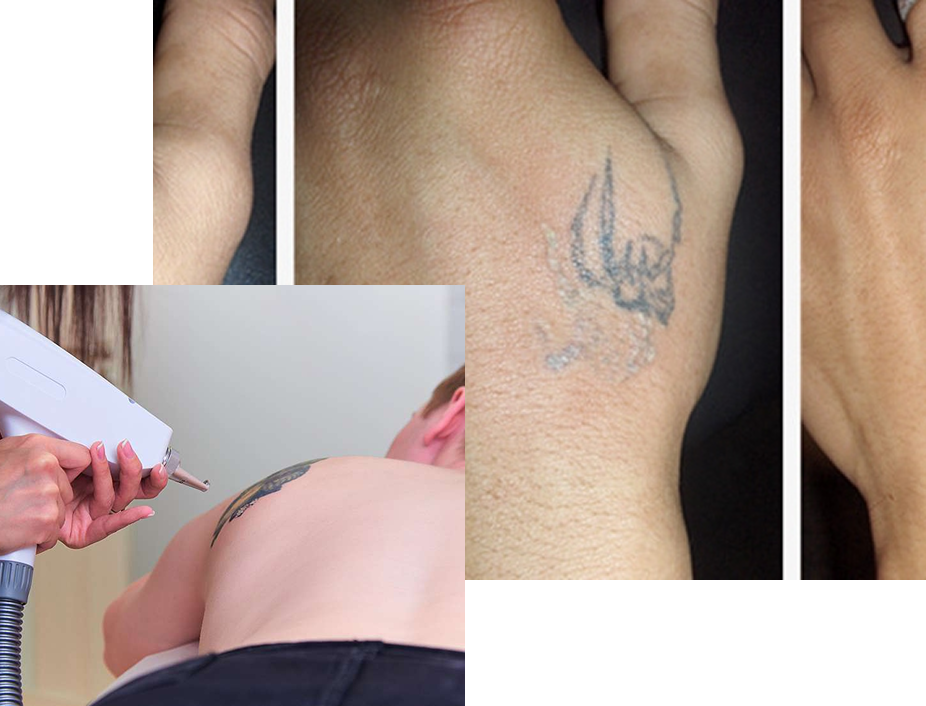 Retiro de Tatuajes Retiro de Tatuajes
