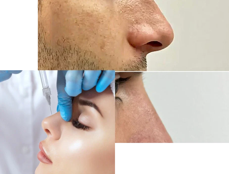 Rinomodelacion Rinomodelacion